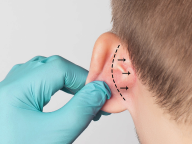 Otoplastia.