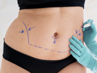 Abdominoplastia.