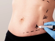 Lipoaspiração.
