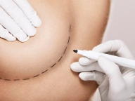Mamoplastia.